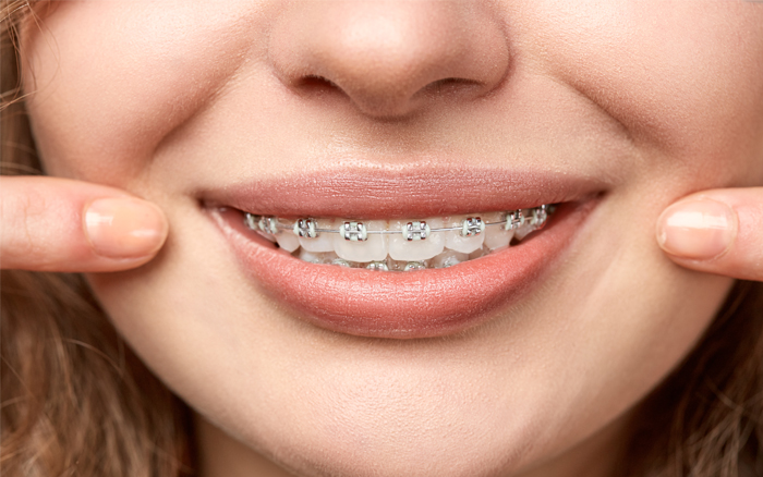 Mitos sobre los brackets